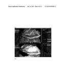 METHOD FOR EVALUATING BLUSH IN MYOCARDIAL TISSUE diagram and image