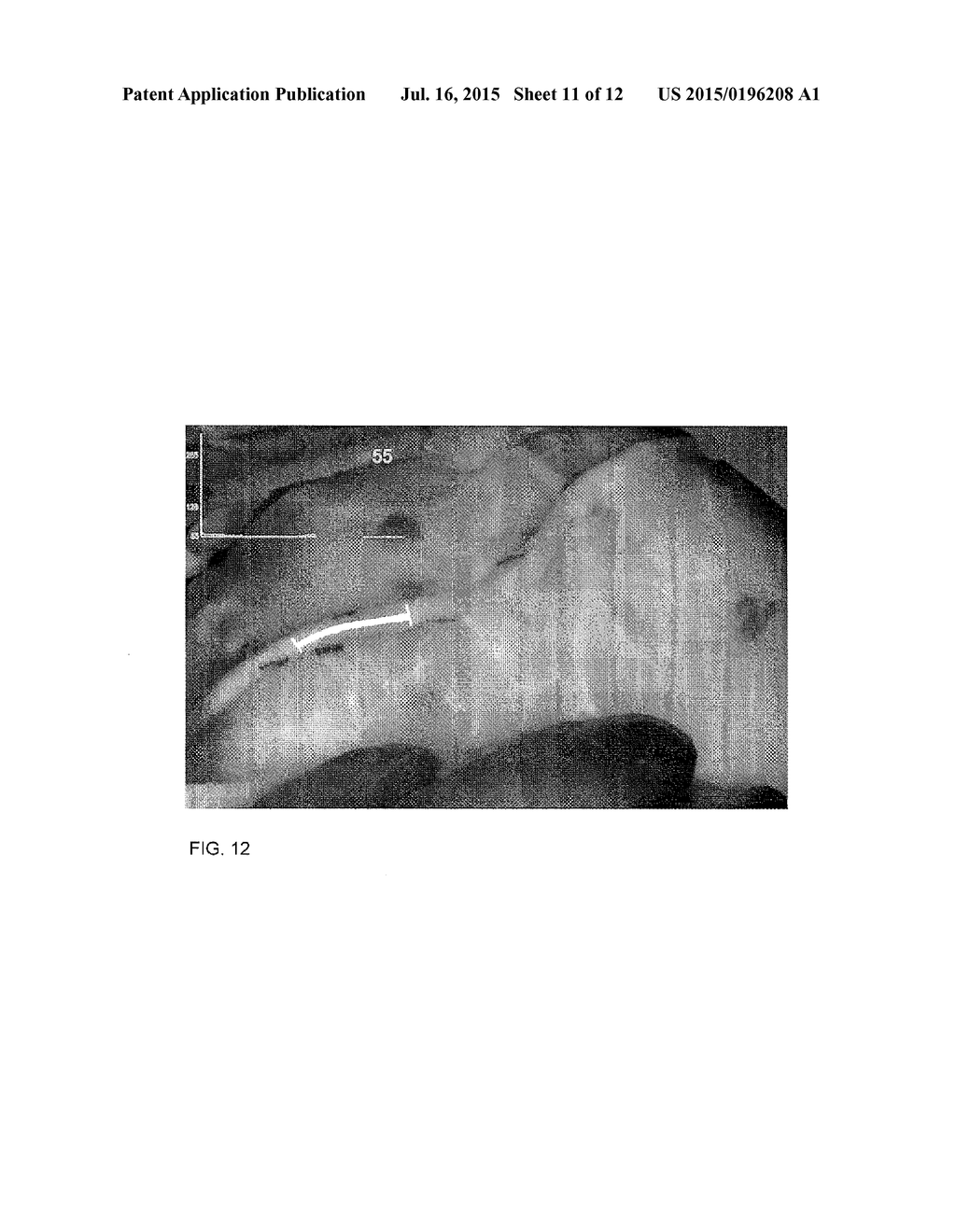 METHOD FOR EVALUATING BLUSH IN MYOCARDIAL TISSUE - diagram, schematic, and image 12