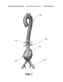 DETECTING ENDOLEAKS ASSOCIATED WITH ANEURYSM REPAIR diagram and image