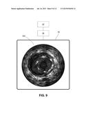 DETECTING ENDOLEAKS ASSOCIATED WITH ANEURYSM REPAIR diagram and image