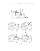 DEVICE TO BE IMPLANTED IN A HUMAN OR ANIMAL BODY FOR MATERIAL OR SIGNAL     DELIVERY OR ACQUISITION WITHIN THE BODY, AND METHOD OF IMPLANTING THE     DEVICE diagram and image