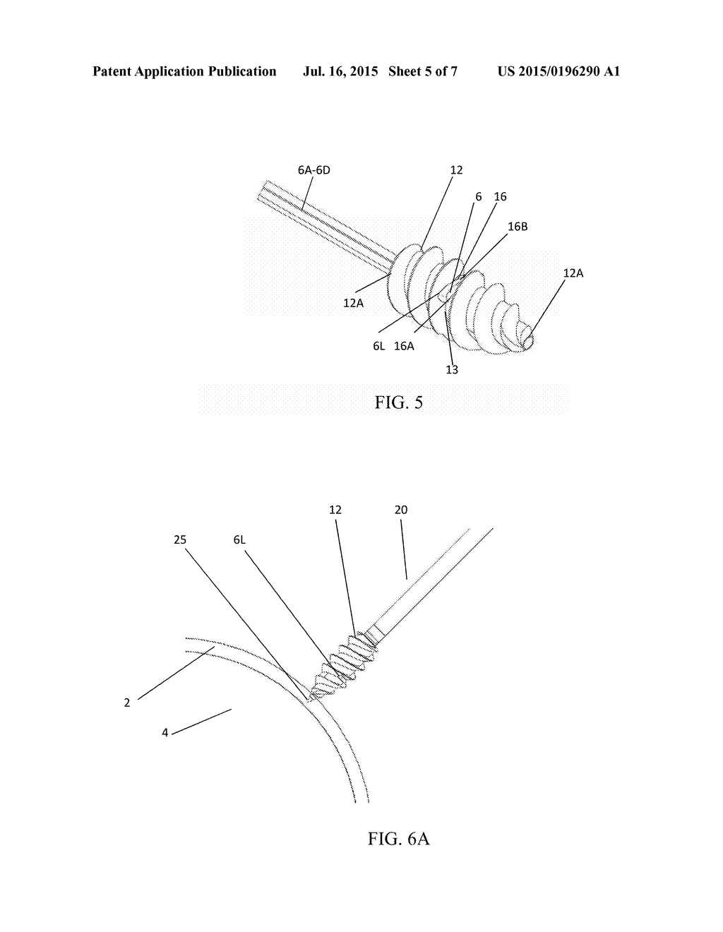 BONE ANCHOR DELIVERY SYSTEM DEVICE WITH SUTURES - diagram, schematic, and image 06