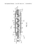 SOFT EMBOLIC IMPLANT diagram and image