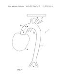 ARTERIAL DEVICE, SYSTEM AND METHOD FOR REMOVING EMBOLIC DEBRIS diagram and image