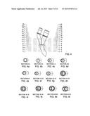 ARTERIAL DEVICE, SYSTEM AND METHOD FOR REMOVING EMBOLIC DEBRIS diagram and image