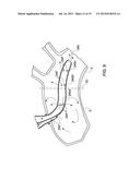 ARTERIAL DEVICE, SYSTEM AND METHOD FOR REMOVING EMBOLIC DEBRIS diagram and image