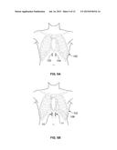 DISSECTING CANNULA AND METHODS OF USE THEREOF diagram and image