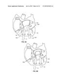 DISSECTING CANNULA AND METHODS OF USE THEREOF diagram and image