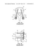 Robot Guided Oblique Spinal Stabilization diagram and image