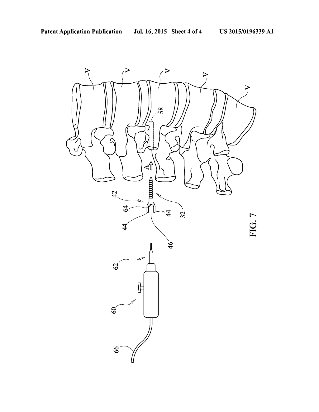 BONE FASTENER WITH IN VIVO RESORBABLE INSULATING COATING FOR     NEURO-MONITORING PURPOSES - diagram, schematic, and image 05