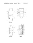 SURGICAL METHOD, KIT OF PARTS, AND IMPLANT diagram and image