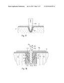 SURGICAL METHOD, KIT OF PARTS, AND IMPLANT diagram and image