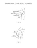 VARIABLE DENSITY TISSUE GRAFT COMPOSITION AND METHODS OF MAKING AND USING     THE SAME diagram and image