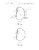 VARIABLE DENSITY TISSUE GRAFT COMPOSITION AND METHODS OF MAKING AND USING     THE SAME diagram and image