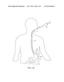 METHODS AND DEVICES FOR DEPLOYING AND RELEASING A TEMPORARY IMPLANT WITHIN     THE BODY diagram and image