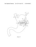 METHODS AND DEVICES FOR DEPLOYING AND RELEASING A TEMPORARY IMPLANT WITHIN     THE BODY diagram and image