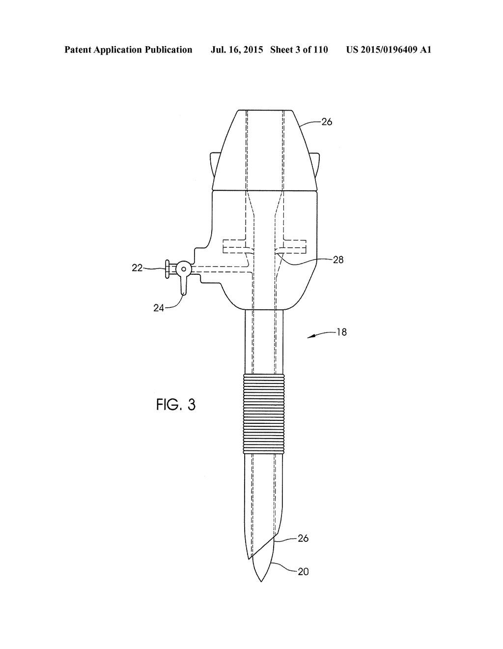 ADJUSTABLE IMPLANT AND METHOD OF USE - diagram, schematic, and image 04