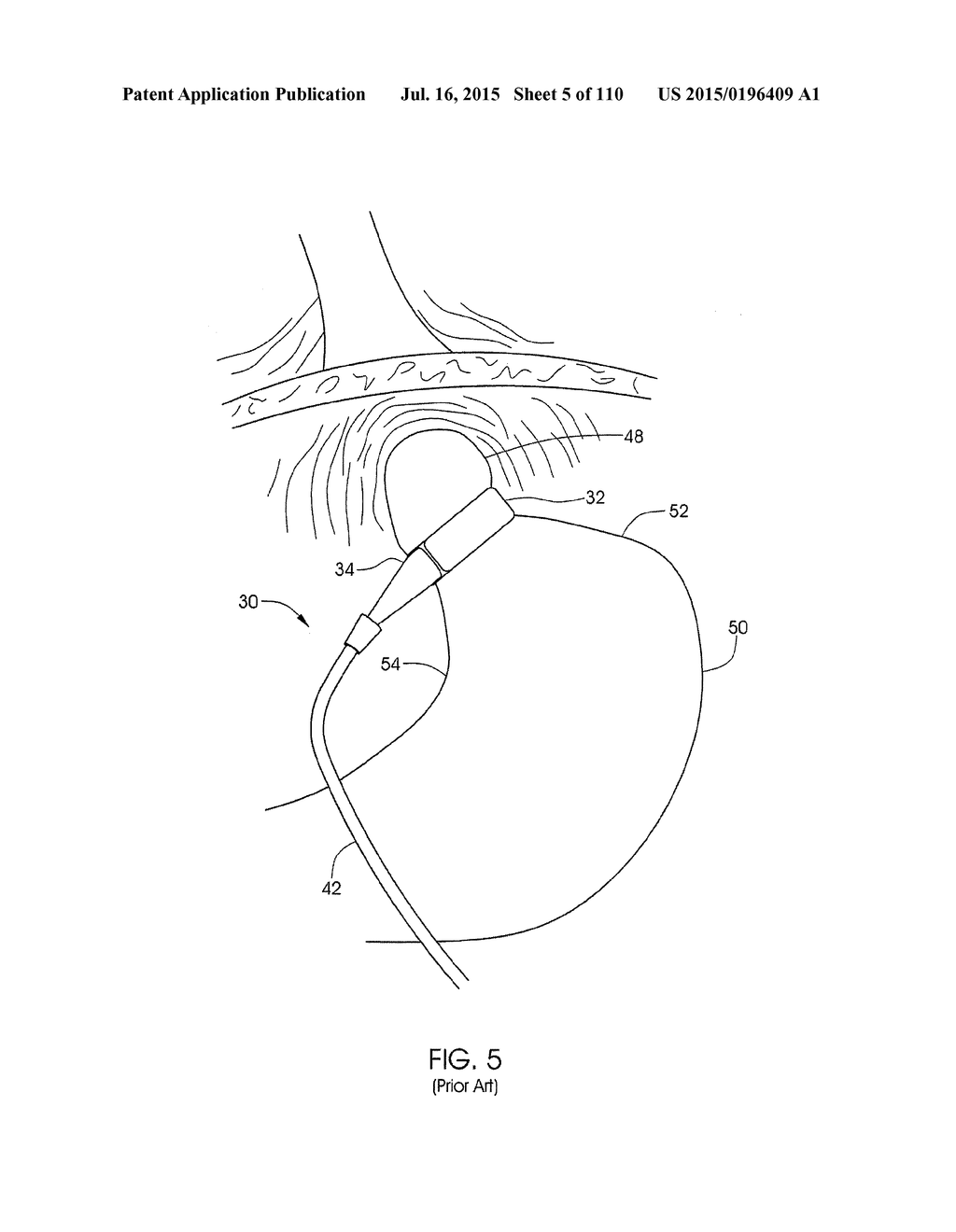 ADJUSTABLE IMPLANT AND METHOD OF USE - diagram, schematic, and image 06