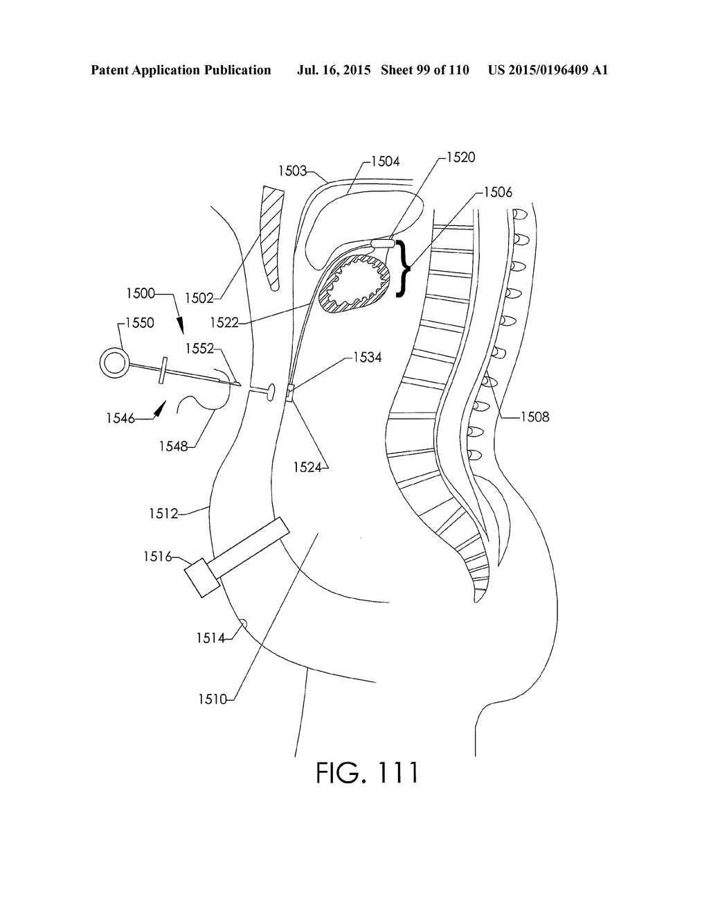 ADJUSTABLE IMPLANT AND METHOD OF USE - diagram, schematic, and image 100