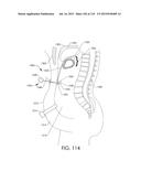 ADJUSTABLE IMPLANT AND METHOD OF USE diagram and image