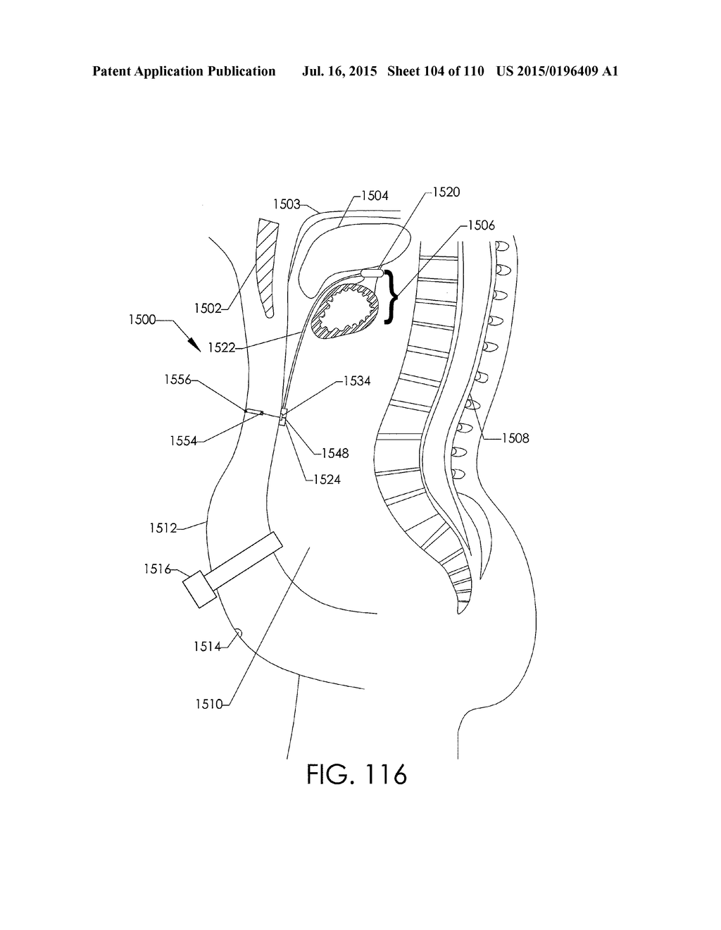 ADJUSTABLE IMPLANT AND METHOD OF USE - diagram, schematic, and image 105