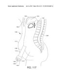 ADJUSTABLE IMPLANT AND METHOD OF USE diagram and image