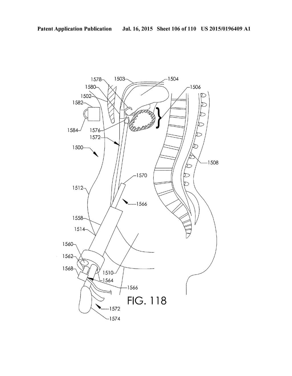 ADJUSTABLE IMPLANT AND METHOD OF USE - diagram, schematic, and image 107