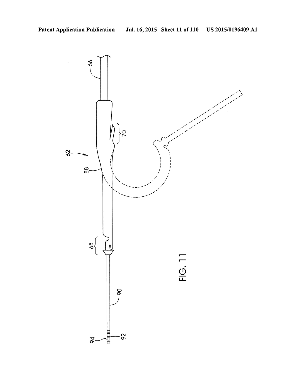 ADJUSTABLE IMPLANT AND METHOD OF USE - diagram, schematic, and image 12