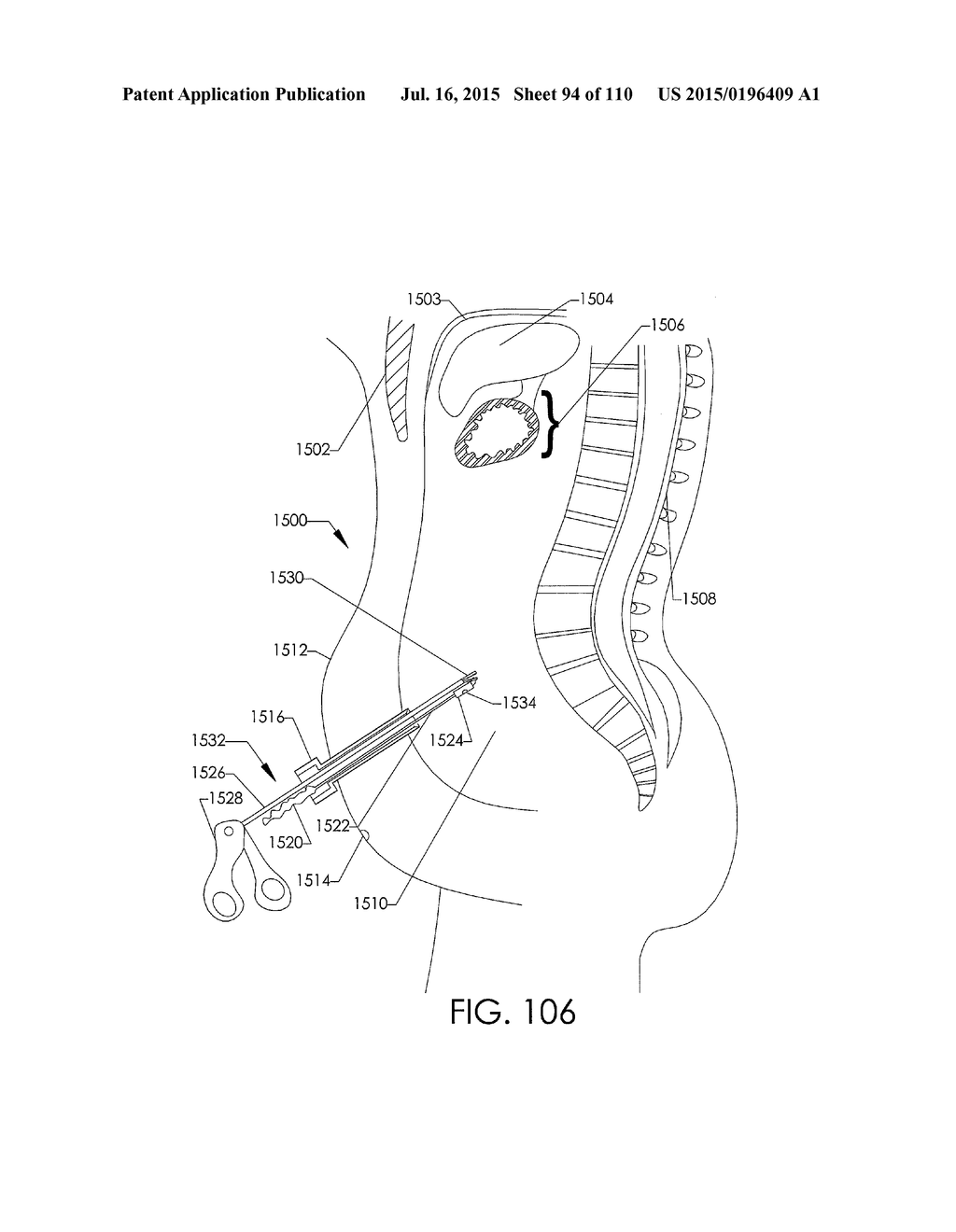 ADJUSTABLE IMPLANT AND METHOD OF USE - diagram, schematic, and image 95
