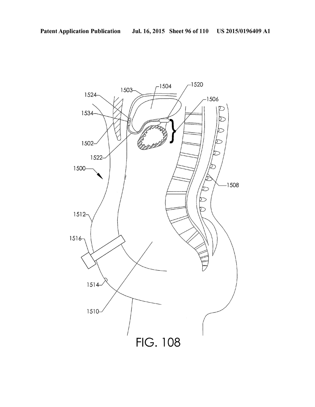 ADJUSTABLE IMPLANT AND METHOD OF USE - diagram, schematic, and image 97