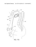 ADJUSTABLE IMPLANT AND METHOD OF USE diagram and image