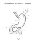 DEVICE, KIT AND METHOD FOR PLACING JEJUNAL TUBE DEVICE THROUGH STOMACH AND     INTO SMALL INTESTINE RELATED APPLICATION diagram and image