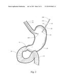 DEVICE, KIT AND METHOD FOR PLACING JEJUNAL TUBE DEVICE THROUGH STOMACH AND     INTO SMALL INTESTINE RELATED APPLICATION diagram and image