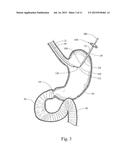 DEVICE, KIT AND METHOD FOR PLACING JEJUNAL TUBE DEVICE THROUGH STOMACH AND     INTO SMALL INTESTINE RELATED APPLICATION diagram and image