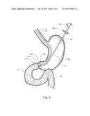 DEVICE, KIT AND METHOD FOR PLACING JEJUNAL TUBE DEVICE THROUGH STOMACH AND     INTO SMALL INTESTINE RELATED APPLICATION diagram and image