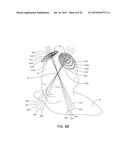 MAGNETIC STIMULATION COILS AND FERROMAGNETIC COMPONENTS FOR REDUCED     SURFACE STIMULATION AND IMPROVED TREATMENT DEPTH diagram and image