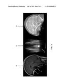 Apparatuses and Methods for Cancellation of Inhomogeneous Magnetic Fields     Induced by Non-Biological Materials Within a Patient s Mouth During     Magnetic Resonance Imaging diagram and image