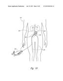 CATHETERS FOR EMERGENCY ENDOVASCULAR SURGERY AND ASSOCIATED DEVICES,     SYSTEMS, AND METHODS diagram and image