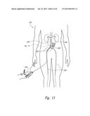 CATHETERS FOR EMERGENCY ENDOVASCULAR SURGERY AND ASSOCIATED DEVICES,     SYSTEMS, AND METHODS diagram and image