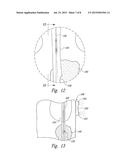 CATHETERS FOR EMERGENCY ENDOVASCULAR SURGERY AND ASSOCIATED DEVICES,     SYSTEMS, AND METHODS diagram and image