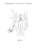 CATHETERS FOR EMERGENCY ENDOVASCULAR SURGERY AND ASSOCIATED DEVICES,     SYSTEMS, AND METHODS diagram and image