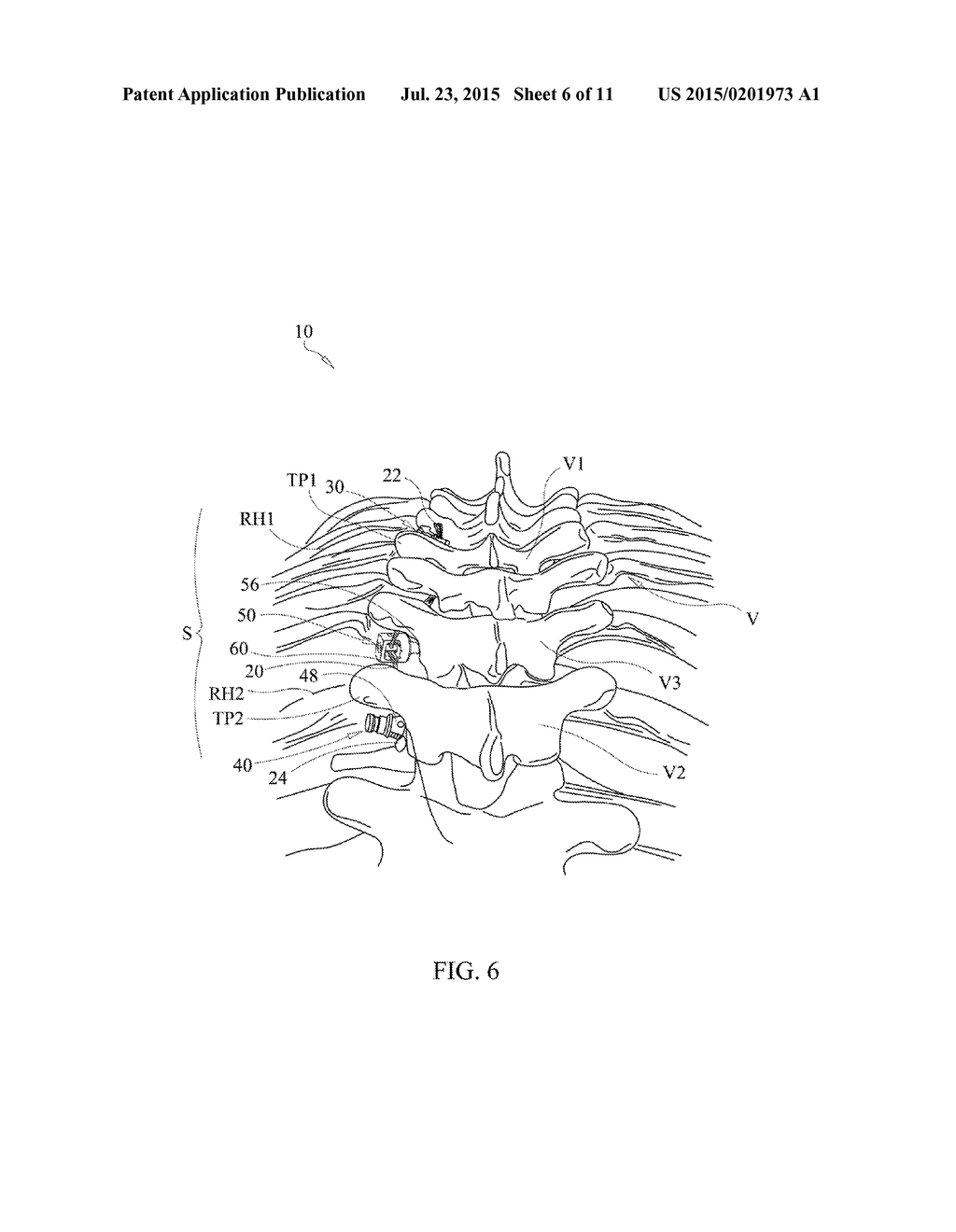 SPINAL CORRECTION SYSTEM AND METHOD - diagram, schematic, and image 07