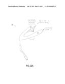 POST NASAL DRIP TREATMENT diagram and image