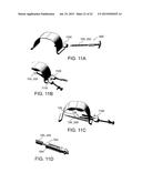 METHOD AND APPARATUS FOR REPAIRING A HERNIA diagram and image