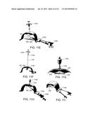 METHOD AND APPARATUS FOR REPAIRING A HERNIA diagram and image