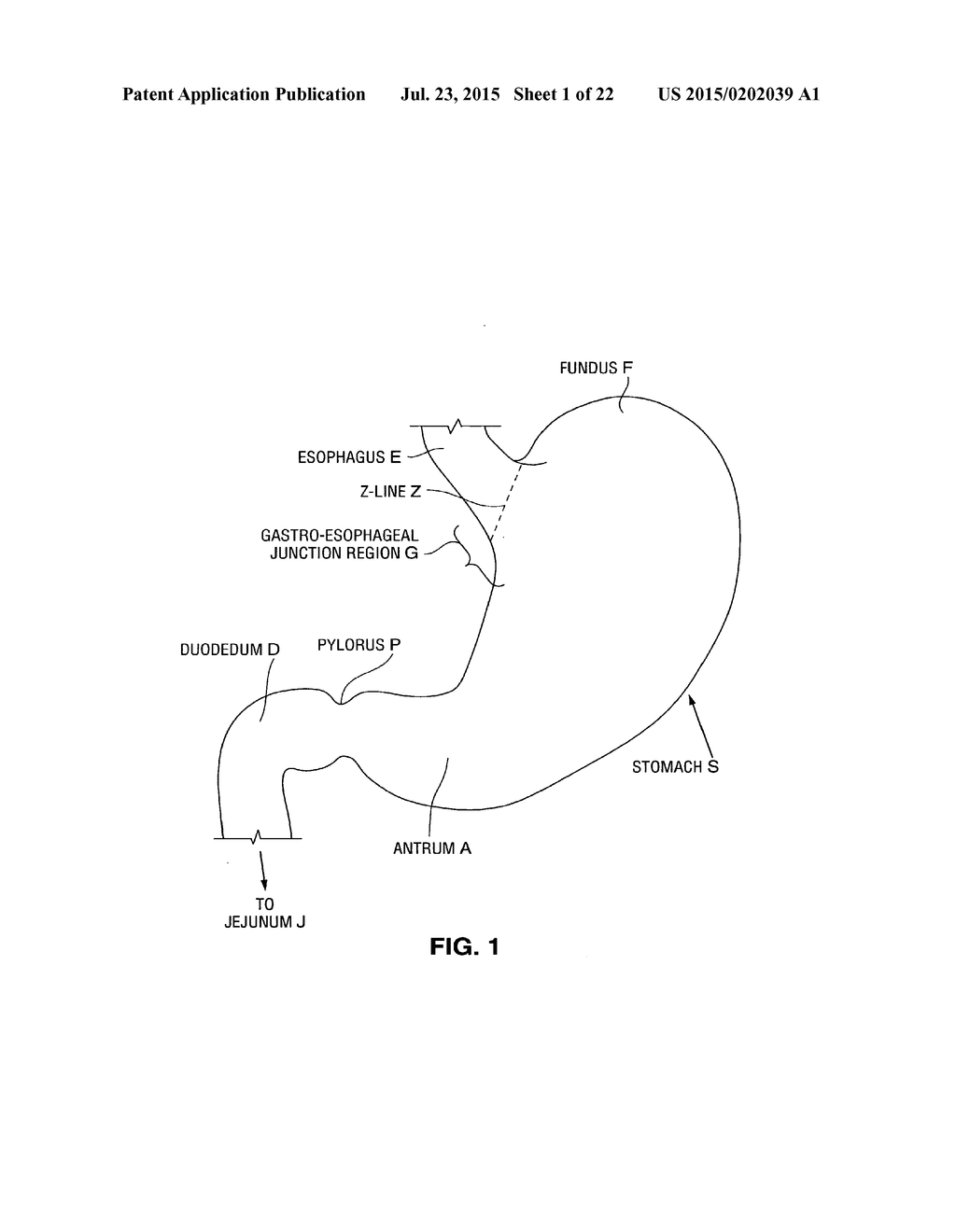 GASTROINTESTINAL IMPLANTS - diagram, schematic, and image 02