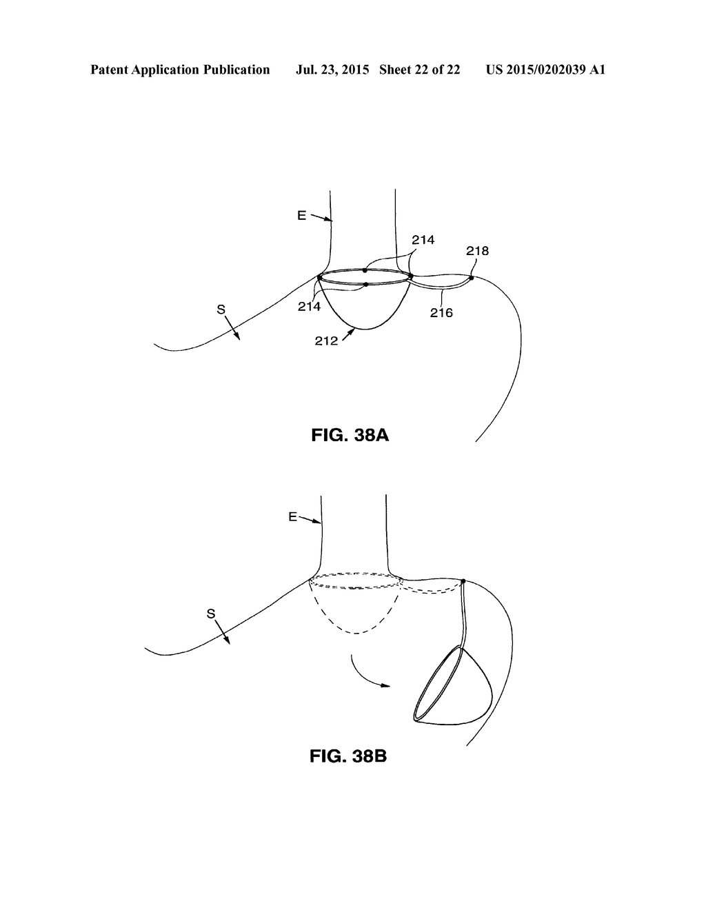 GASTROINTESTINAL IMPLANTS - diagram, schematic, and image 23