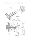 SPINAL FUSION SYSTEM diagram and image