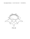 IN-SITU FORMED INTERVERTEBRAL FUSION DEVICE AND METHOD diagram and image