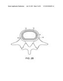 IN-SITU FORMED INTERVERTEBRAL FUSION DEVICE AND METHOD diagram and image